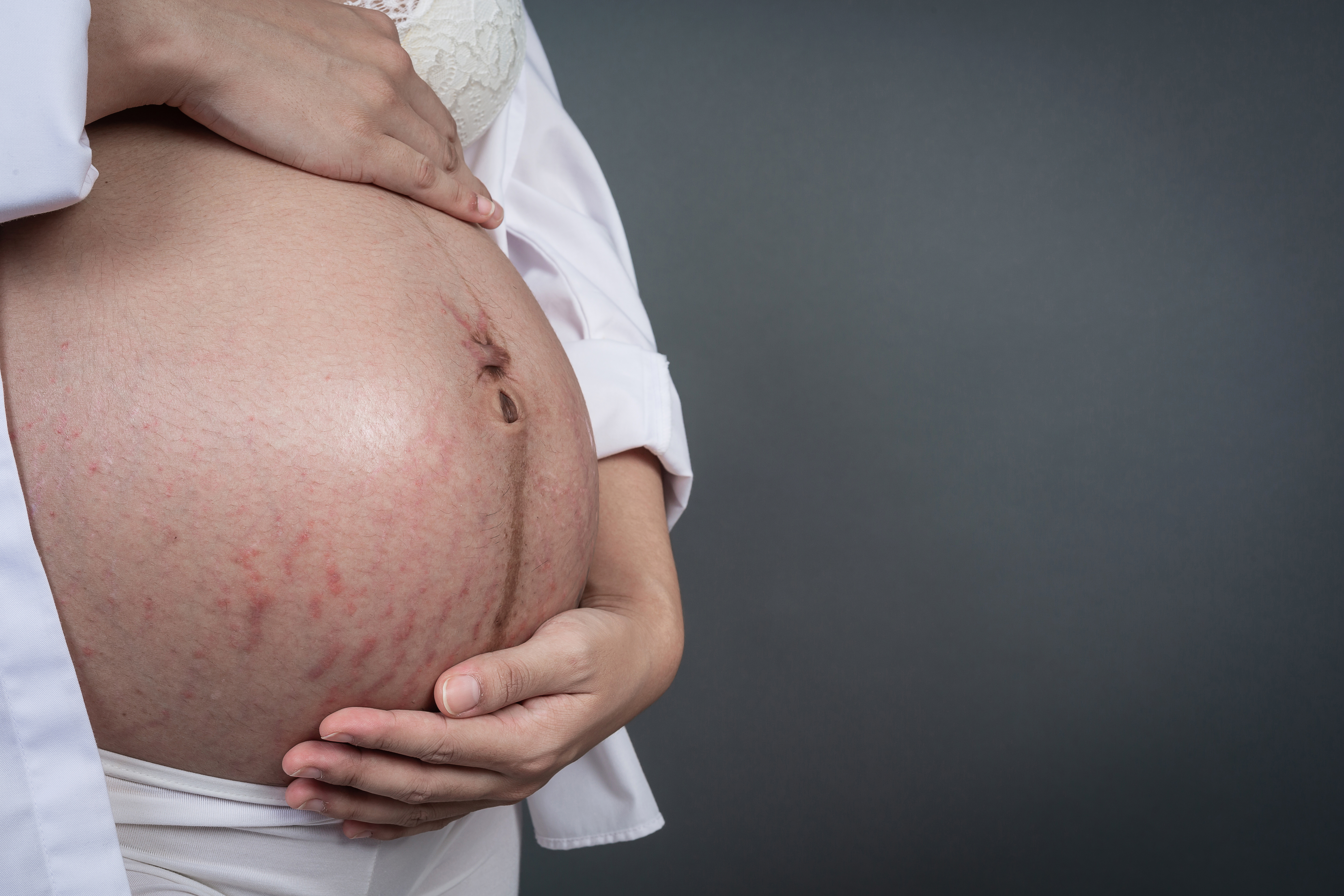 Femme enceinte vergetures